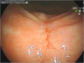 4.内視鏡切除から2ヶ月後完全に潰瘍瘢痕となり治癒のイメージ