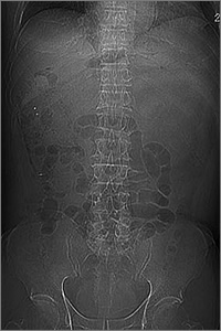 二酸化炭素送気装置を使用するとレントゲン写真