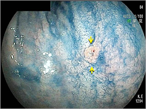 発見時の色素内視鏡写真