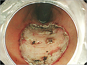 胃癌を含む粘膜が内視鏡的に切除された後の状態のイメージ