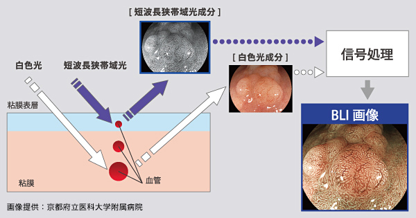 BLI（Blue LASER Imaging）画像